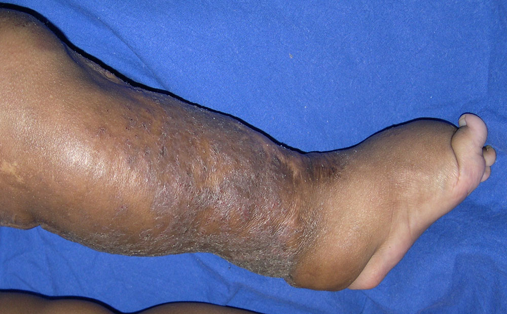 Lymphödem mit Schwellung des Fußes
