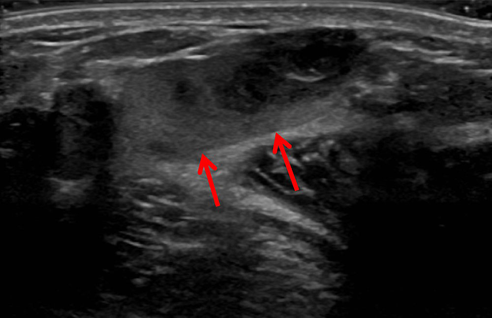 Thrombophlebitis innerhalb einer venösen Malformation im Ultraschallbild