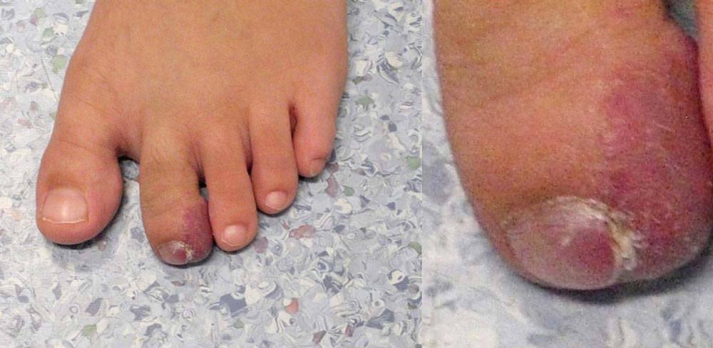 Arteriovenöse Malformation an Fuß – Nagelbettentzündung