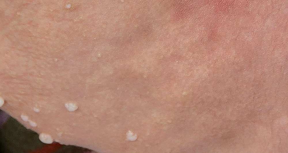Lymphvesikel an der Haut bei lymphatischer Malformation