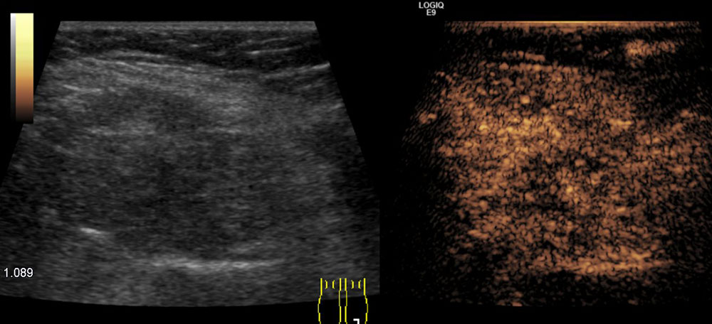 Ultraschallbild von chronischem Schmerzsyndrom bei FAVA ín der Wadenmuskulatur