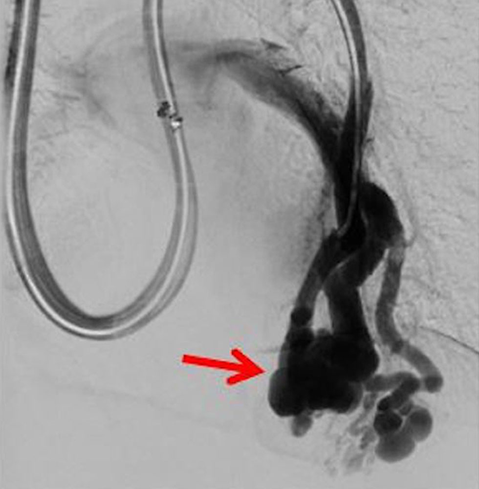 Arteriovenöse Malformation – HHT-Morbus Osler