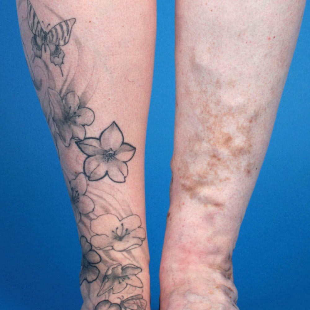 Tattoo bei arteriovenöser Malformation an Bein