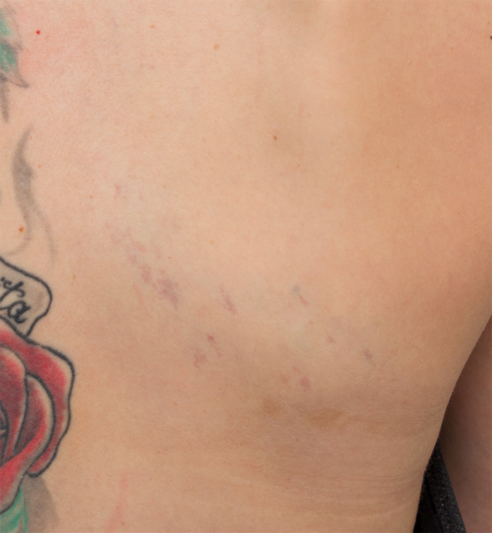 Tattoo bei venöser Malformation an Rücken